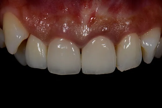 オールセラミック症例