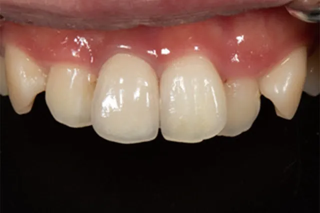 ジルコニア症例